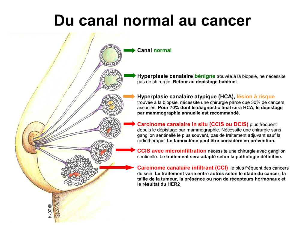 cancer du sein schéma